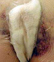 scar 3 days after surgery