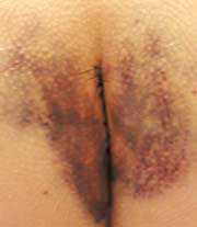 scar 4 days after surgery