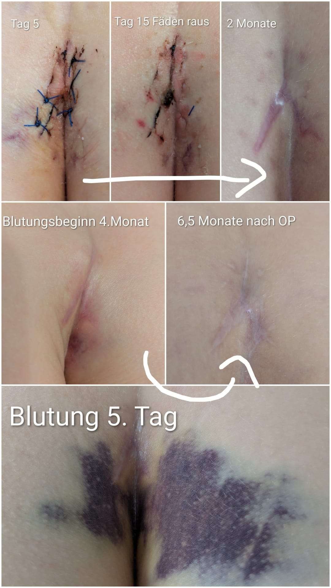 Alice coccygectomy