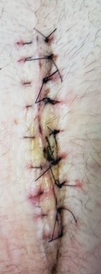 wound at day 14