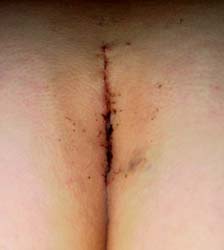 scar at day 11