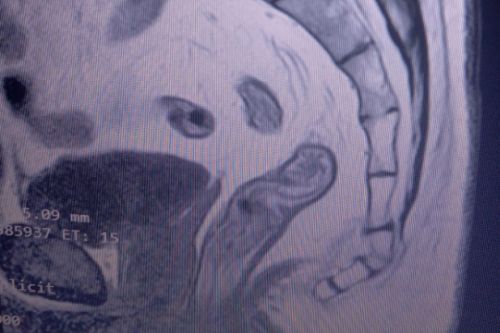 Francesco coccyx