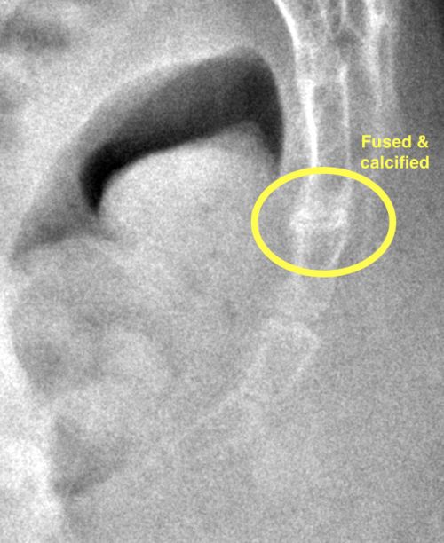 fused coccyx