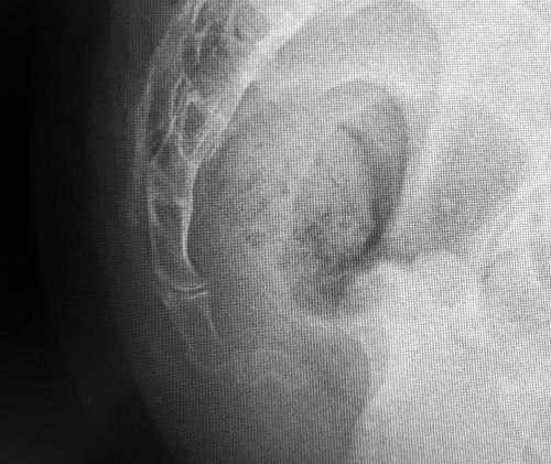 John hooked tailbone