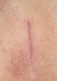 scar at 2 weeks