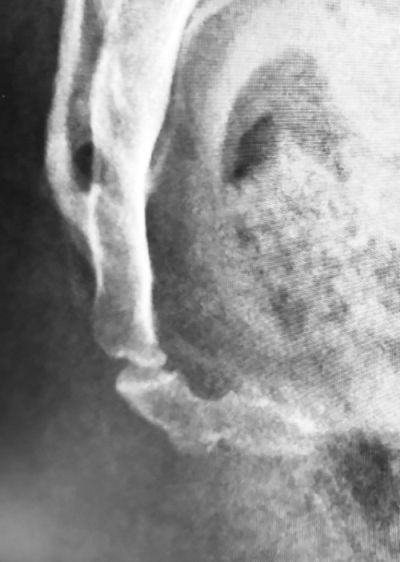 x-ray of Tim's coccyx